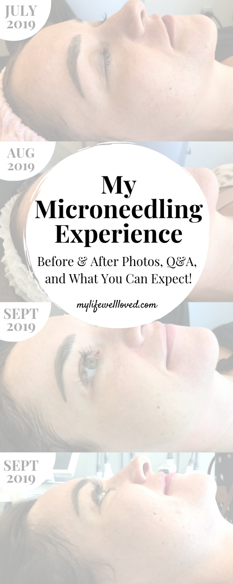 A Complete Microneedling Experience FAQ: Everything You Should Know by Life + Style Blogger, Heather Brown // My Life Well Loved