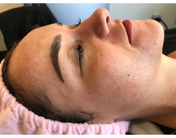 A Complete Microneedling Experience FAQ: Everything You Should Know by Life + Style Blogger, Heather Brown // My Life Well Loved